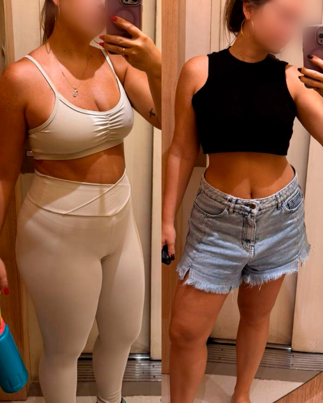 Antes e depois de paciente acompanhado pelo Dr. Vagner de Mello — resultado 5