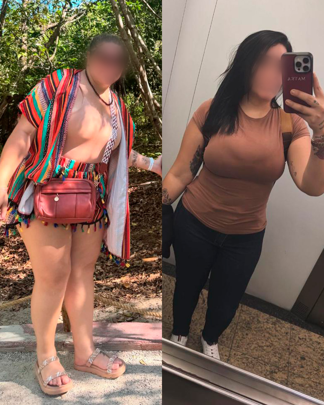Antes e depois de paciente acompanhado pelo Dr. Vagner de Mello — resultado 1