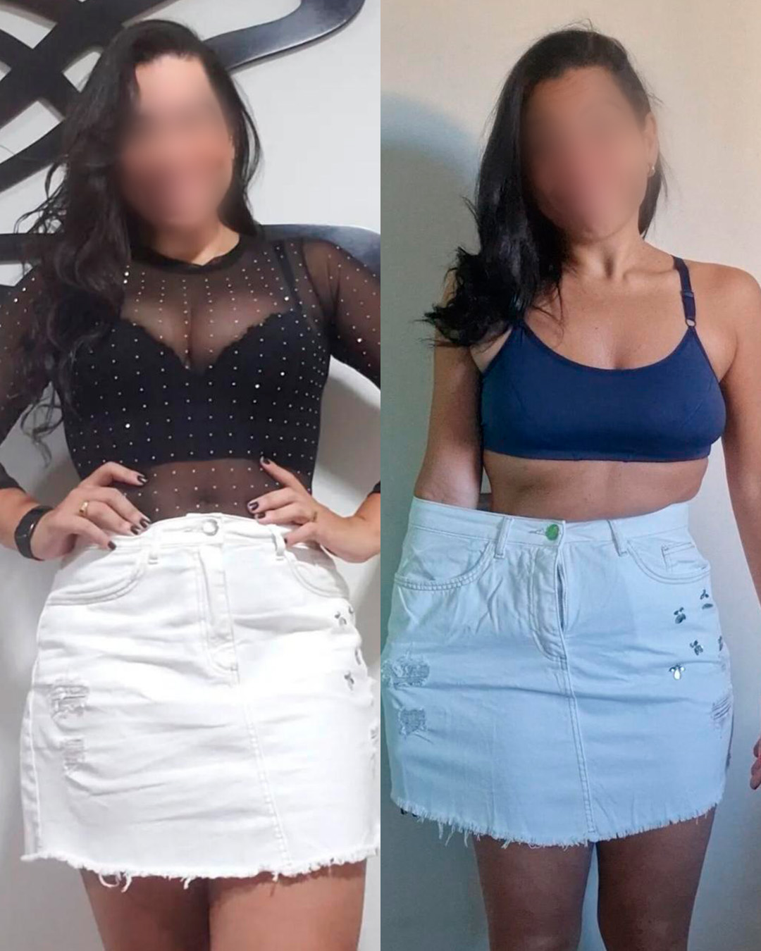 Antes e depois de paciente acompanhado pelo Dr. Vagner de Mello — resultado 2