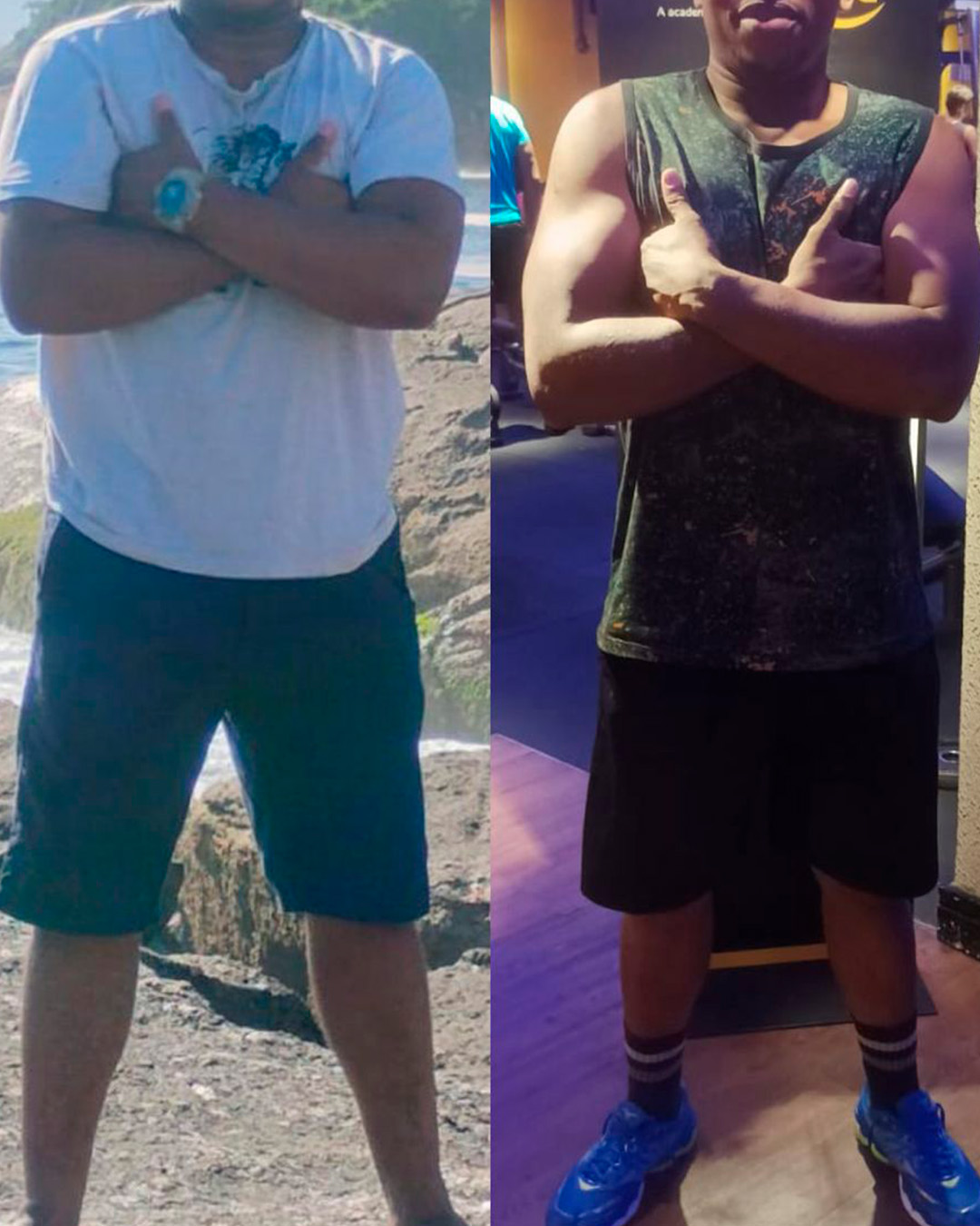 Antes e depois de paciente acompanhado pelo Dr. Vagner de Mello — resultado 9
