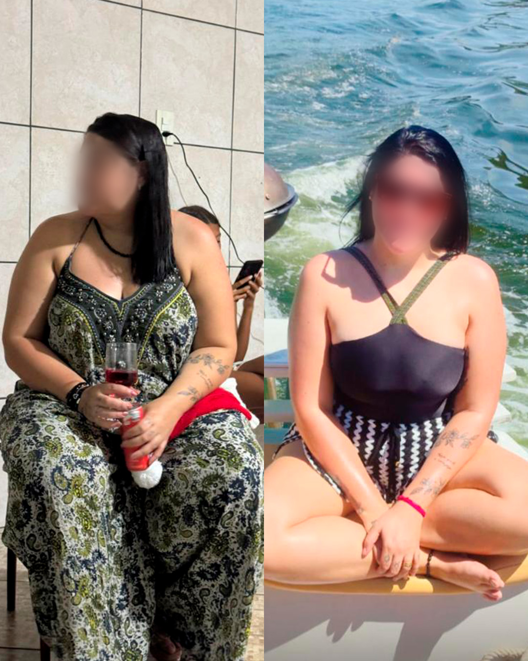 Antes e depois de paciente acompanhado pelo Dr. Vagner de Mello — resultado 3