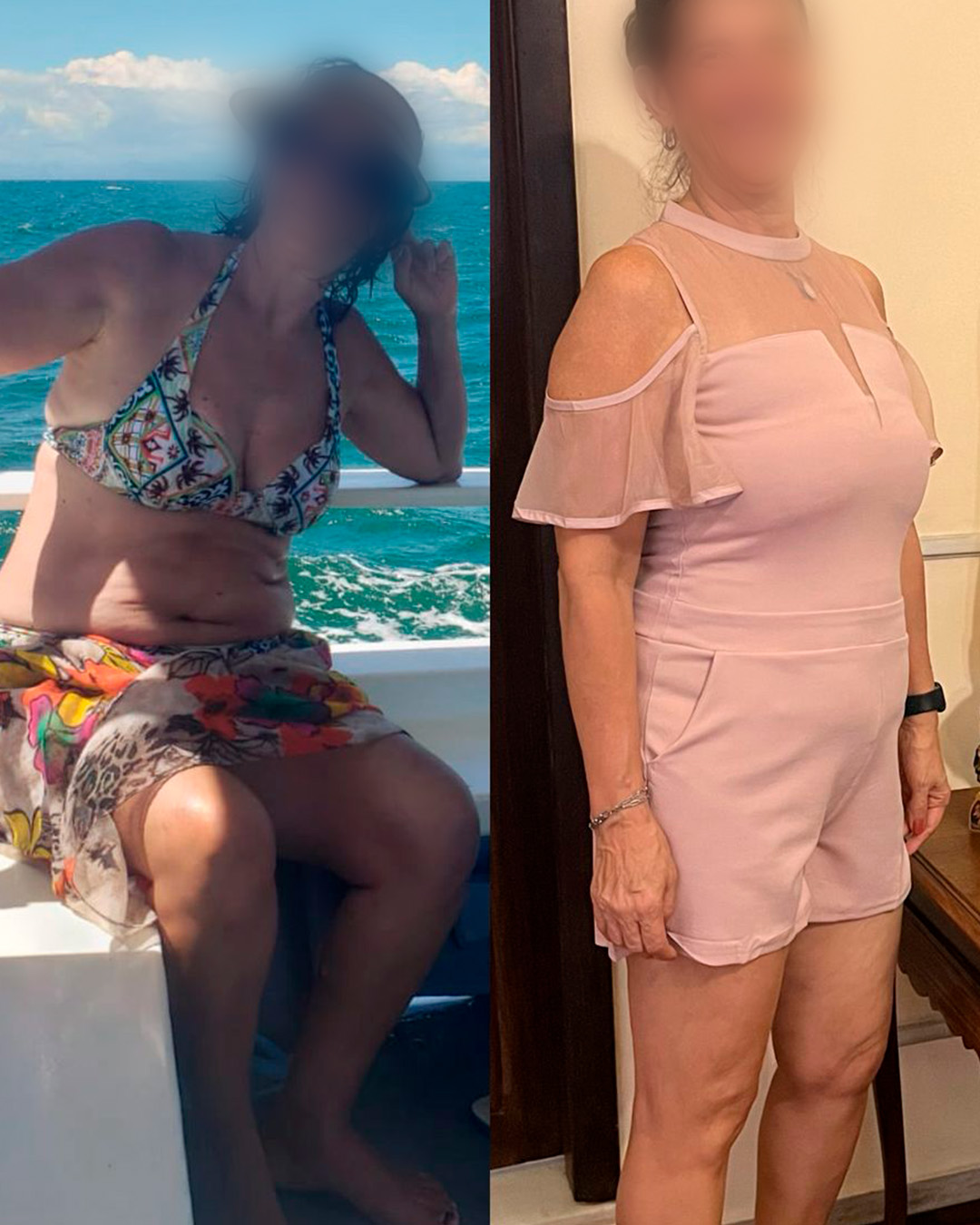 Antes e depois de paciente acompanhado pelo Dr. Vagner de Mello — resultado 8