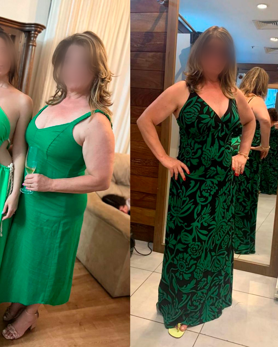 Antes e depois de paciente acompanhado pelo Dr. Vagner de Mello — resultado 6
