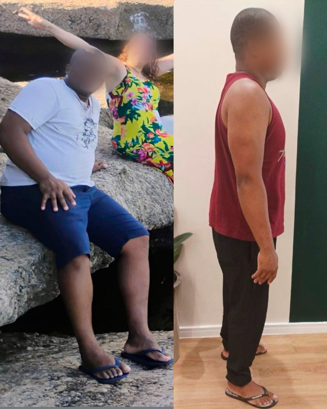 Antes e depois de paciente acompanhado pelo Dr. Vagner de Mello — resultado 7