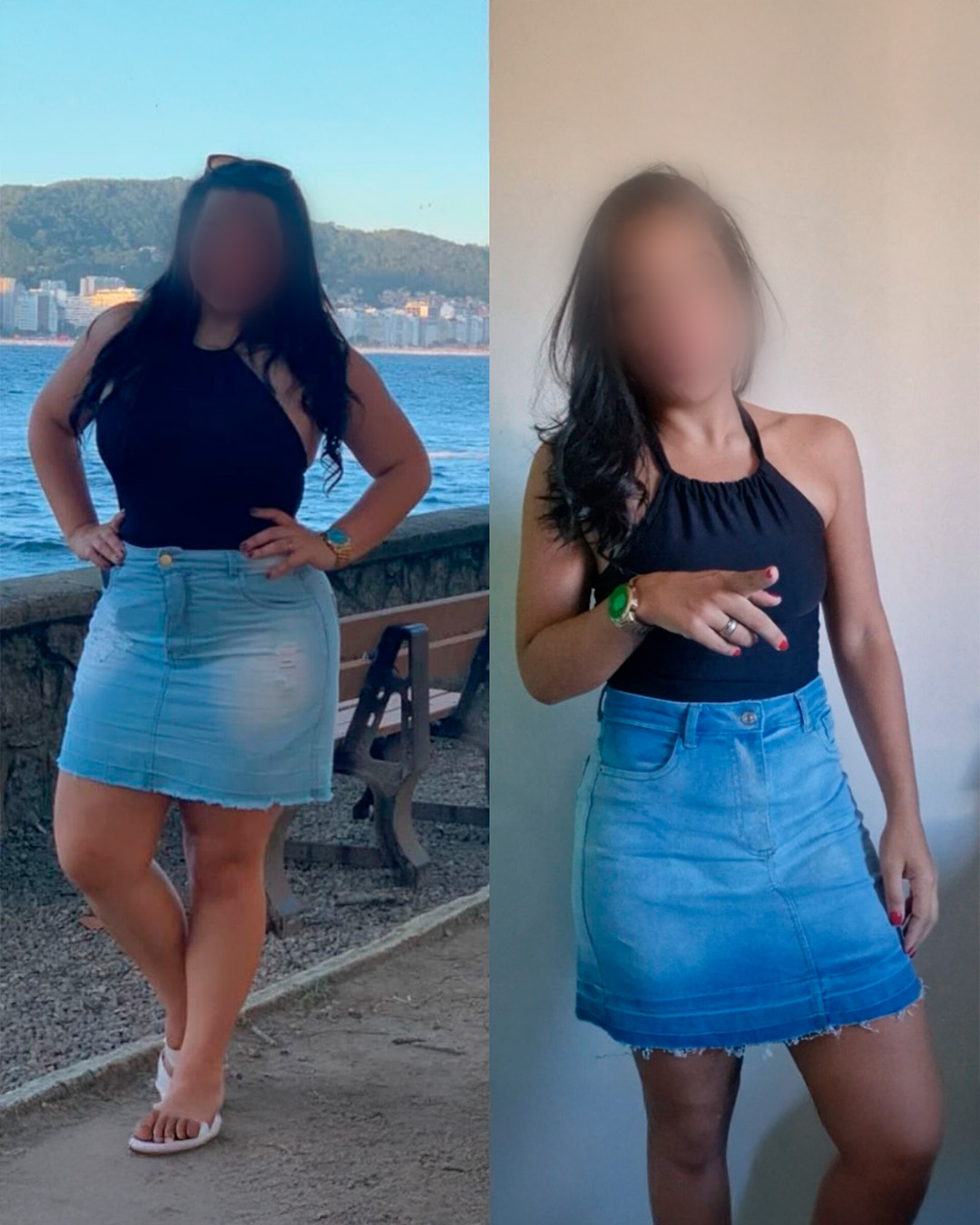 Antes e depois de paciente acompanhado pelo Dr. Vagner de Mello — resultado 4